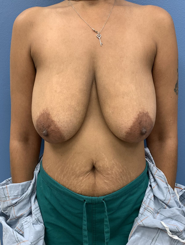 Breast Lift case #2702