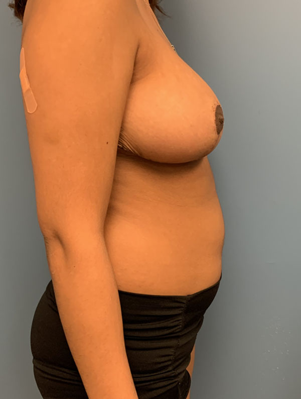 Breast Reduction case #2822