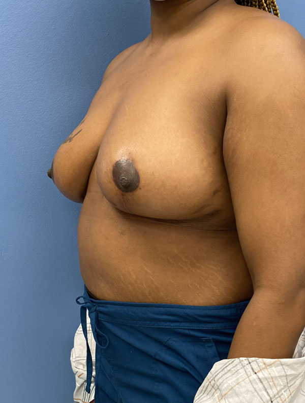 Breast Reduction case #2944