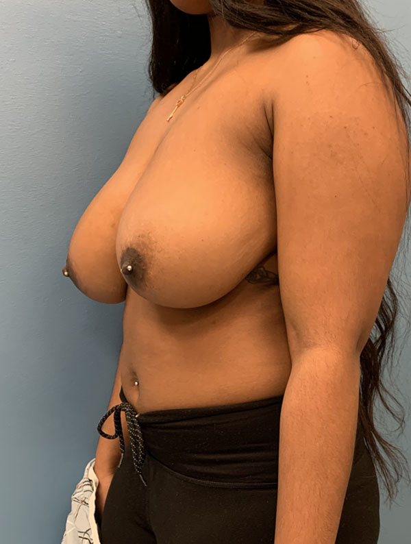 Breast Reduction case #2790