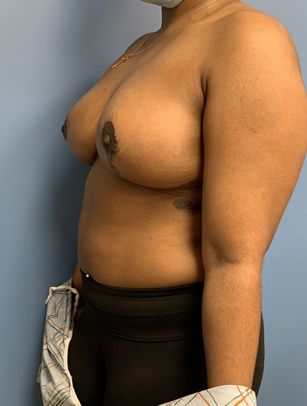 Breast Reduction case #2790