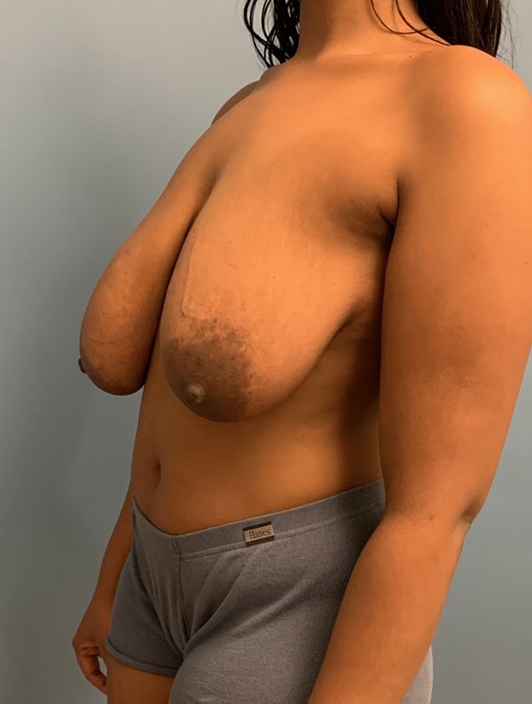 Breast Reduction case #2812